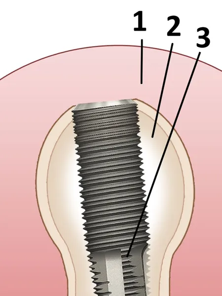 Straumann Implantate